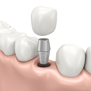 Dental Implants Abroads