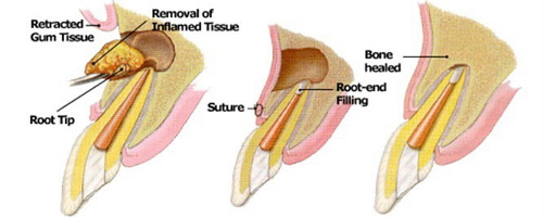 apical resection abroad