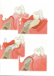 bone graft abroad