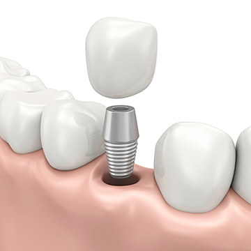 dental implant abroad